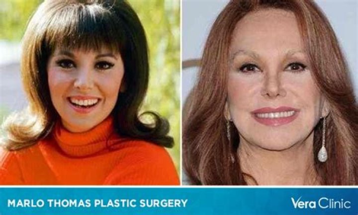 Exploring Marlo Thomas and Her Journey Through Plastic Surgery